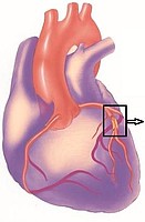 Restringimento (stenosi) dell’arteria coronaria