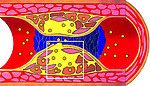Dislocation de la plaque avec caillot sanguin (thrombus)