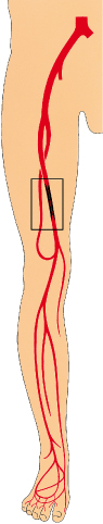 Durchblutungsstörungen in den Beinen